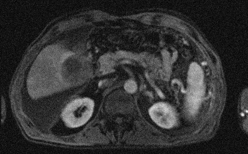 Metal artifact correction MRI paper figure